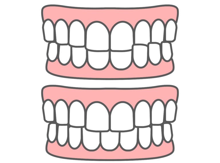噛み合わせが反対の歯並び(交叉咬合)